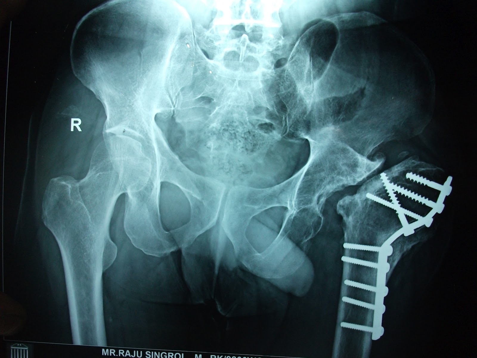 Joint Preservation and Replacement August 2012