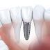 Cách giảm đau và sưng tấy sau trồng răng implant