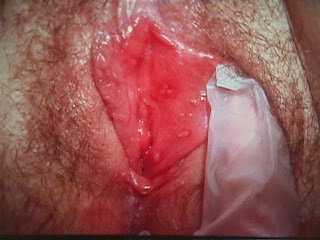 genital warts vagina pictures genital warts vagina pictures