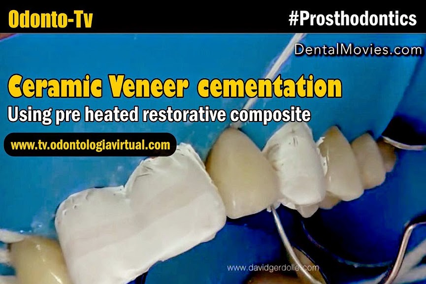 CERAMIC VENEER Cementation using pre heated restorative composite