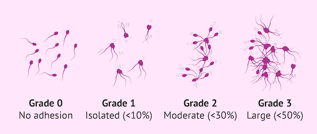 Grade Sperma Aglutinasi Positif Grade Sperma Aglutinasi Positif