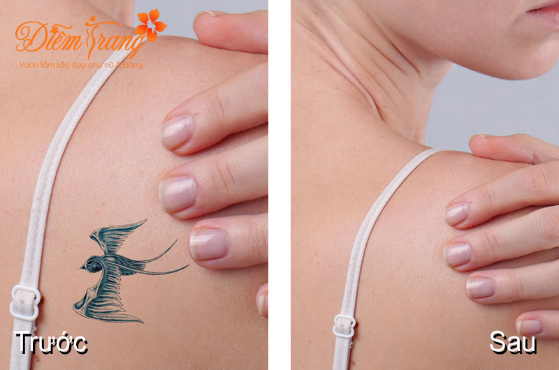 Trước và sau khi xóa xăm tại Diễm Trang Trước và sau khi xóa xăm tại Diễm Trang