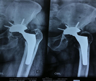 artroplastia de quadril