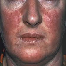 acne rosacea polycythemia vera face psoriasis rid treatment comedones skin examination adult causes dermatology symptoms blood ayurvedic pimples physical comedonal