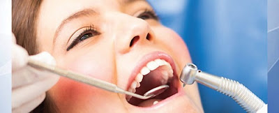 Khắc phục sâu răng sau khi niềng răng 