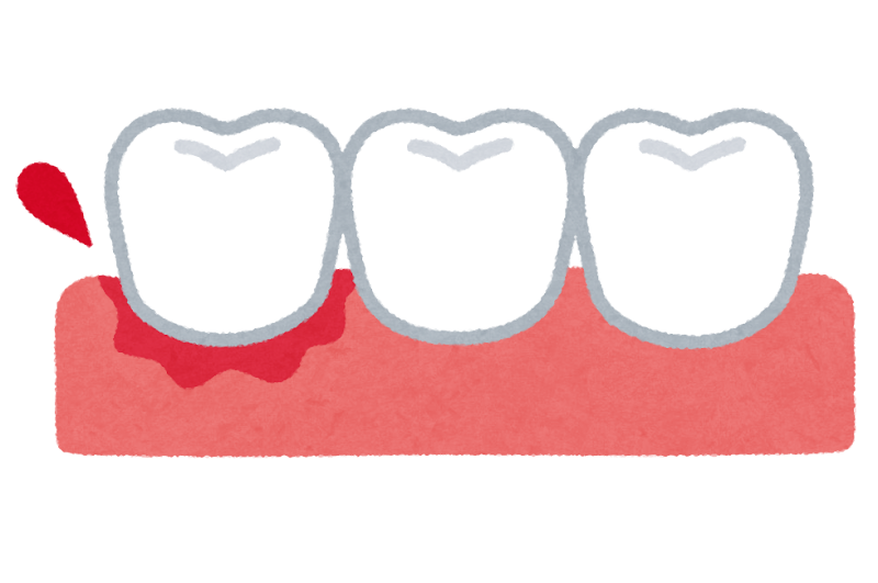 歯ブラシの長期使用はむし歯や歯周病の原因になる あきる野市の年中無休の歯医者 きらら歯科