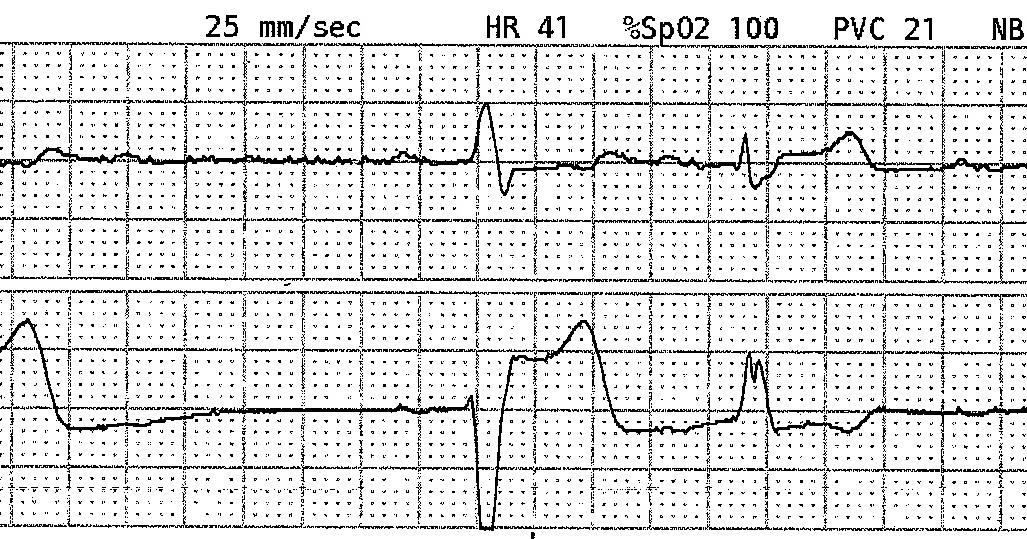 ECG Rhythms Bradycardia with Alternating Bundle Branch Block