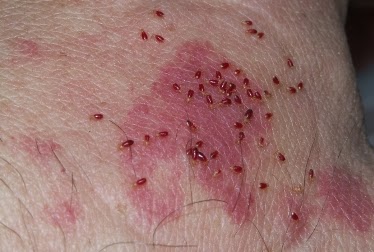 Image result for Bed Bug Allergy