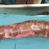 Médicos retiram mandioca de 45 cm de homem que a usou como brinquedo...