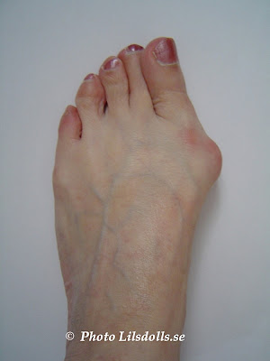 hallux valgus, halluxvalgus-operation, fot före op