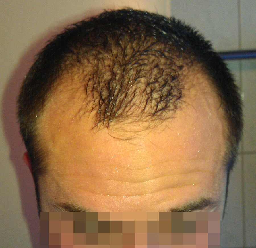 Hair Win Los Mejores Transplantes Capilares Del Mundo Dr Abdul Muttalip Keser V Paciente 29 Anos Nw 3 Excelente Caso 2100 Grafts