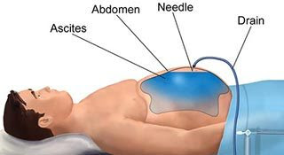 Cara Mengatasi Penumpukan Cairan Berlebihan Di Dalam Rongga Perut (Asites) Cara Mengatasi Penumpukan Cairan Berlebihan Di Dalam Rongga Perut (Asites)