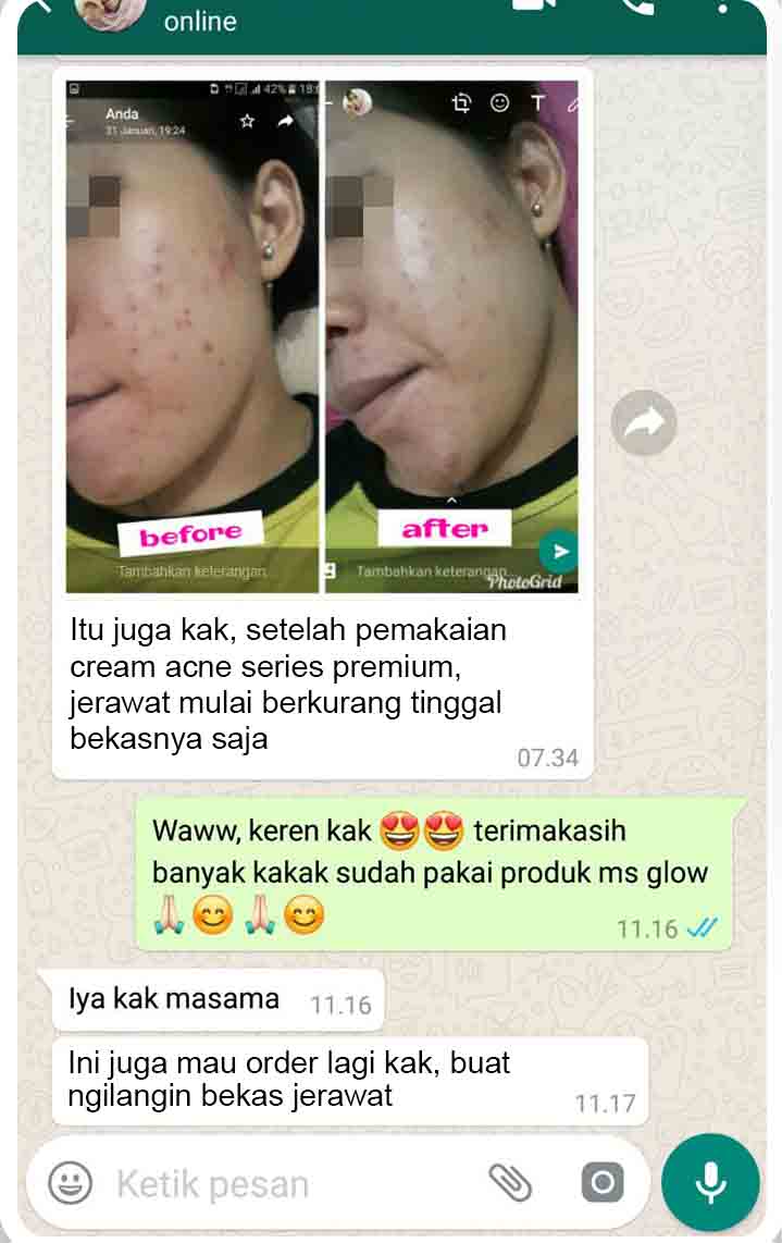 Review Ms Glow Acne Premium BPOM Testimoni , Harga beserta Manfaat