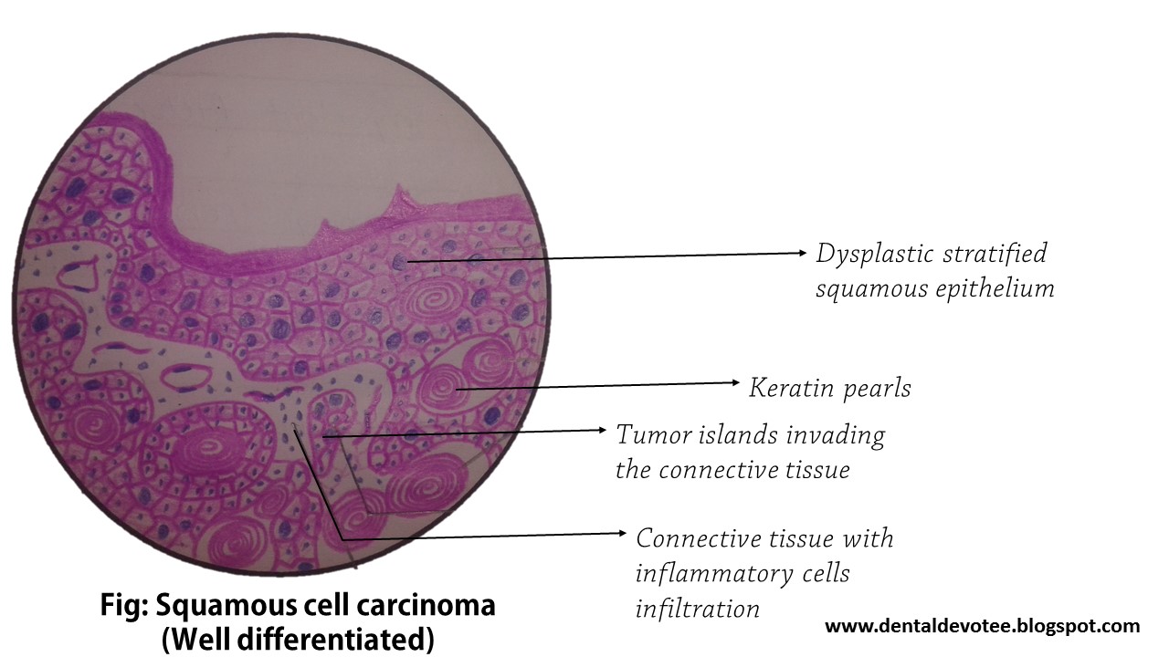Cysts of oral cavity pdf picture