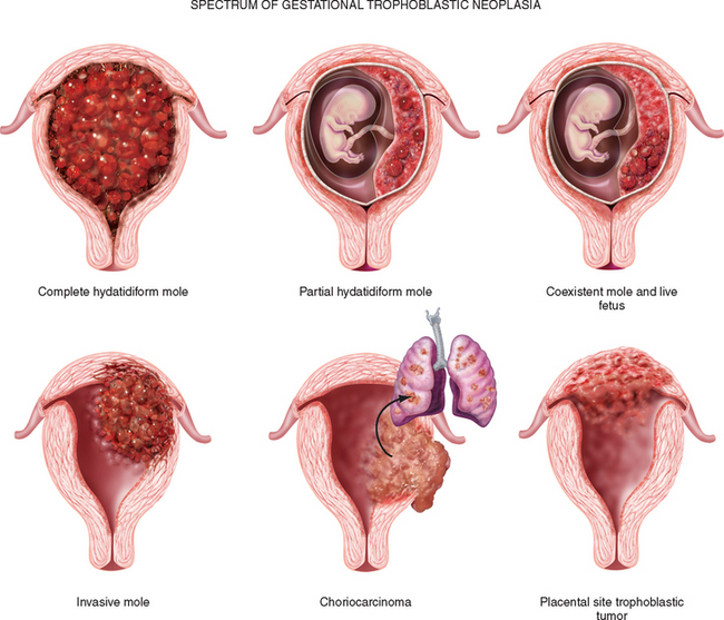 pathophysiology og vaginal bleeding of h-mole chinese pussy wet