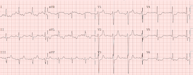 Dr. Smith's ECG Blog: Is this Acute Ischemia? More on LVH.