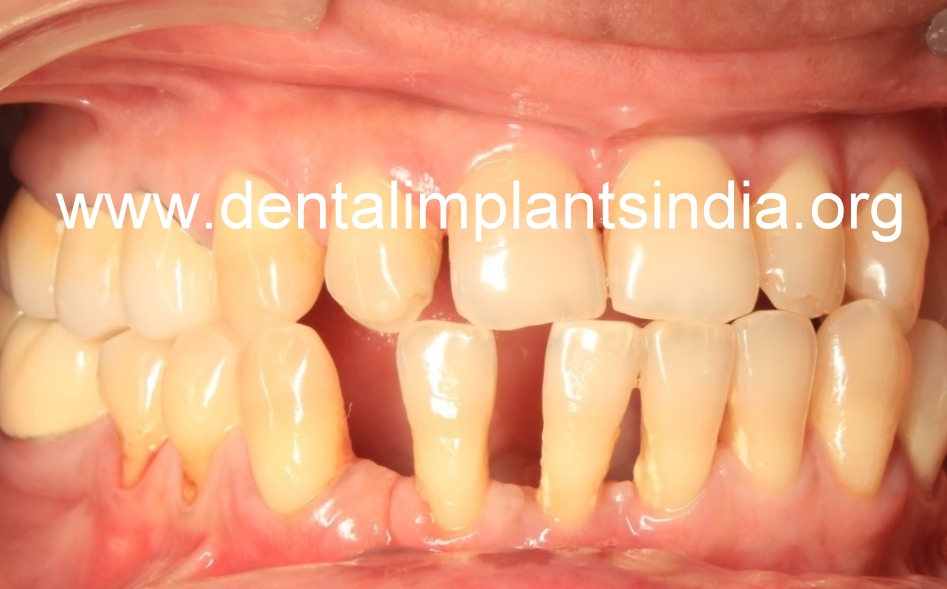 Chinthamani Laser Dental Clinic BASAL IMPLANTS WITHOUT