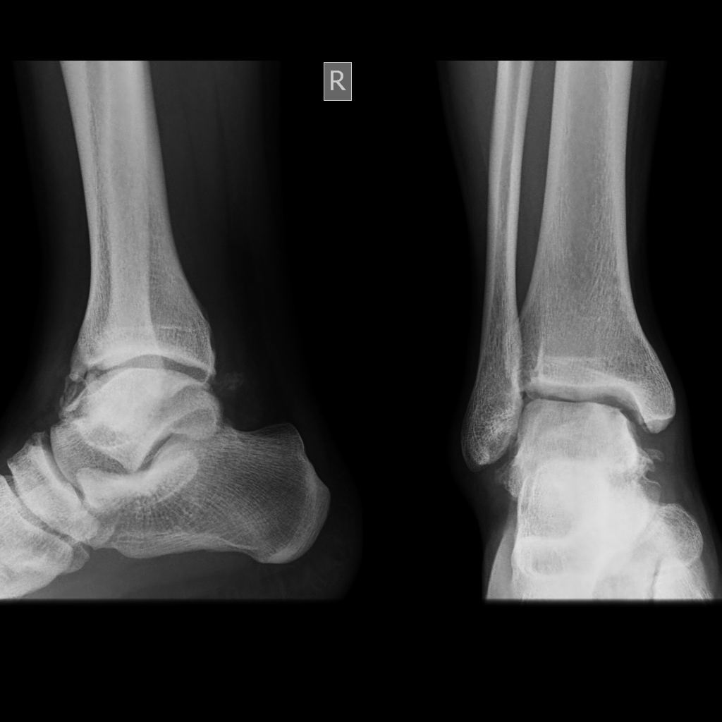 Joint Preservation and Replacement 18 year old adolescent footballer