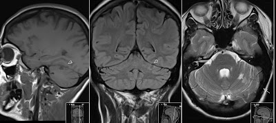 Basilaris Thrombosis - Radiology Imaging
