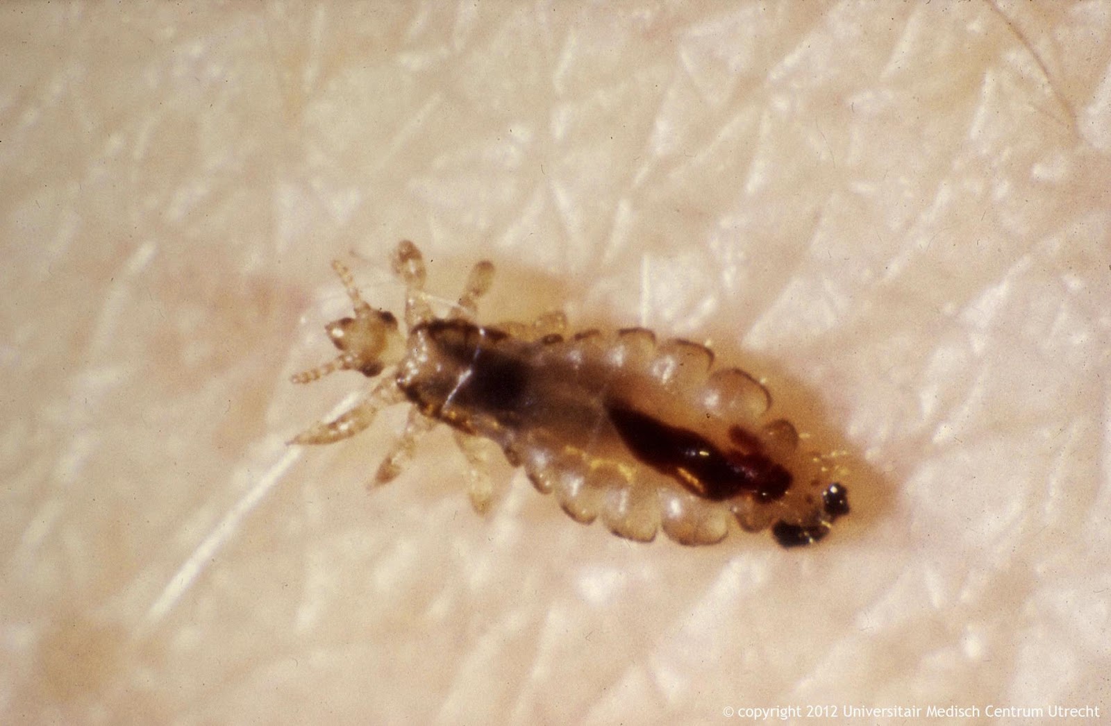 Head Lice Pictures 62