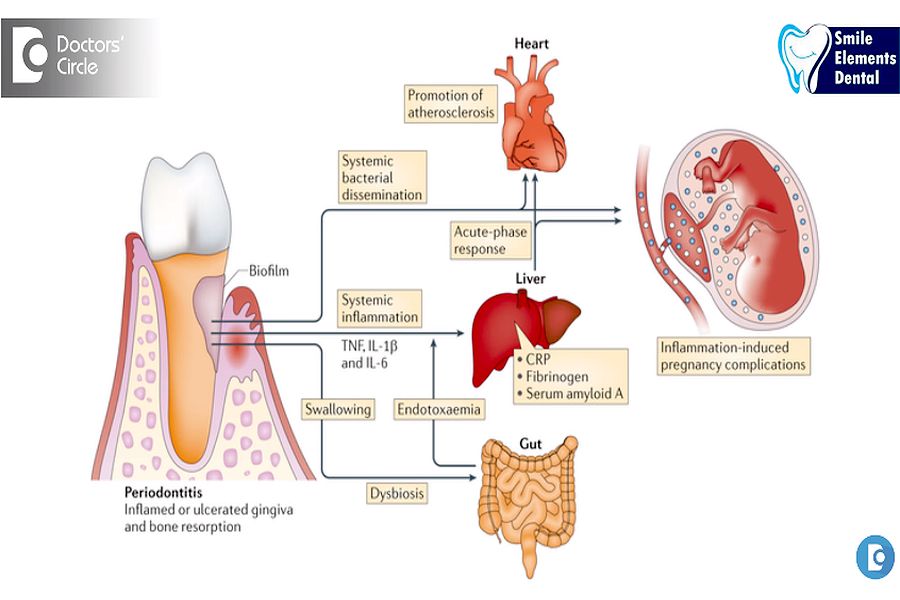 PERIODONTICS Can poor oral health cause heart disease? Dr. Sangeeta