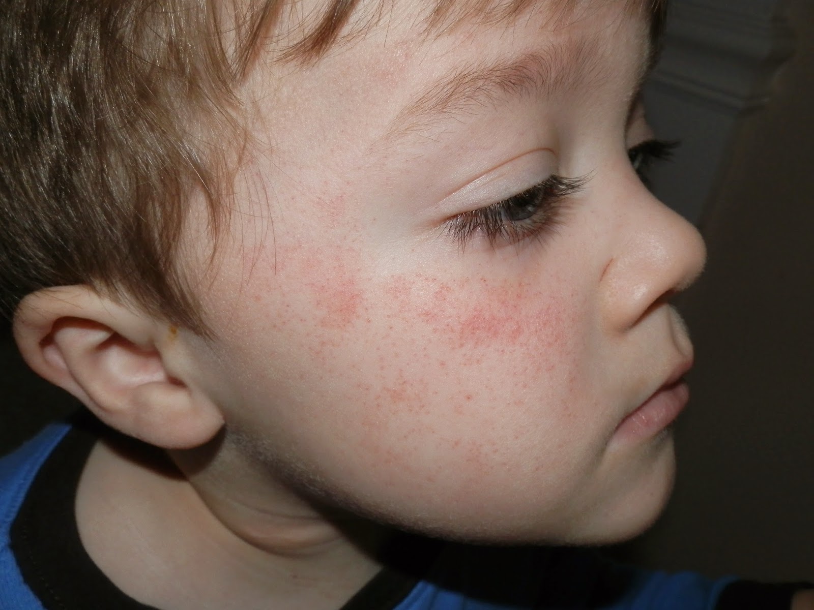 Why Does My Face Have Red Patches