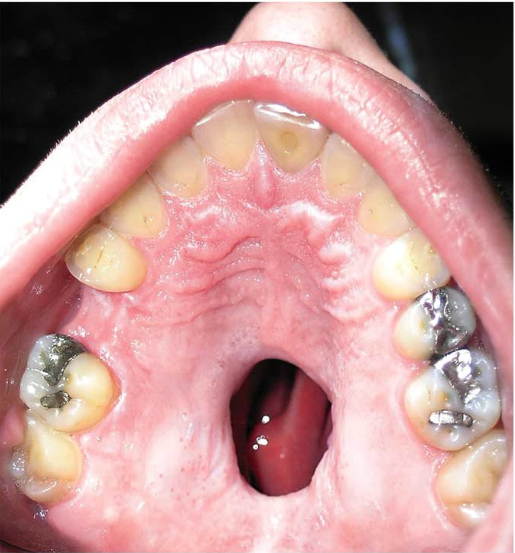 Resultado de imagem para Dentista fica chocado com o que vê dentro da boca de paciente e alerta