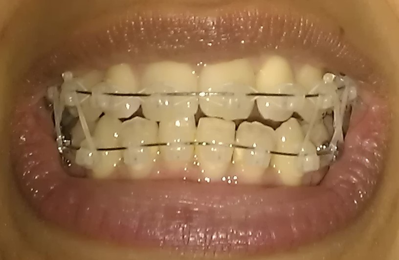 My Damon Clear Braces Week 8 continued Elastic/Rubber Bands