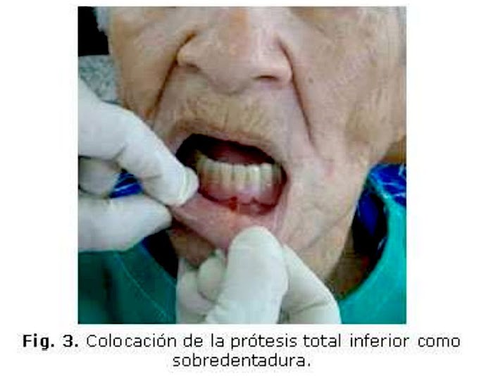 PDF: Rehabilitación protésica con Sobredentadura en una longeva