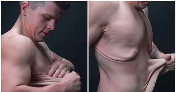 Drenagem linfatica pos bariatrica Clearance