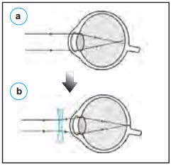 Astigmatism: ce trebuie să știi despre această afecțiune?