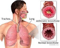 gejala penyebab penyakit asma