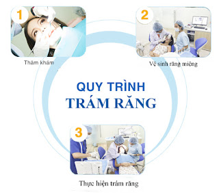 Quy trình trám răng sâu chuẩn tại Nha khoa KIM