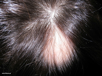 Μαλλιά τριχόπτωση αλωπεκία
