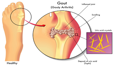 Gout High Uric Acid