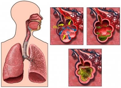 gambar paru paru basah pengobatan paru paru basah