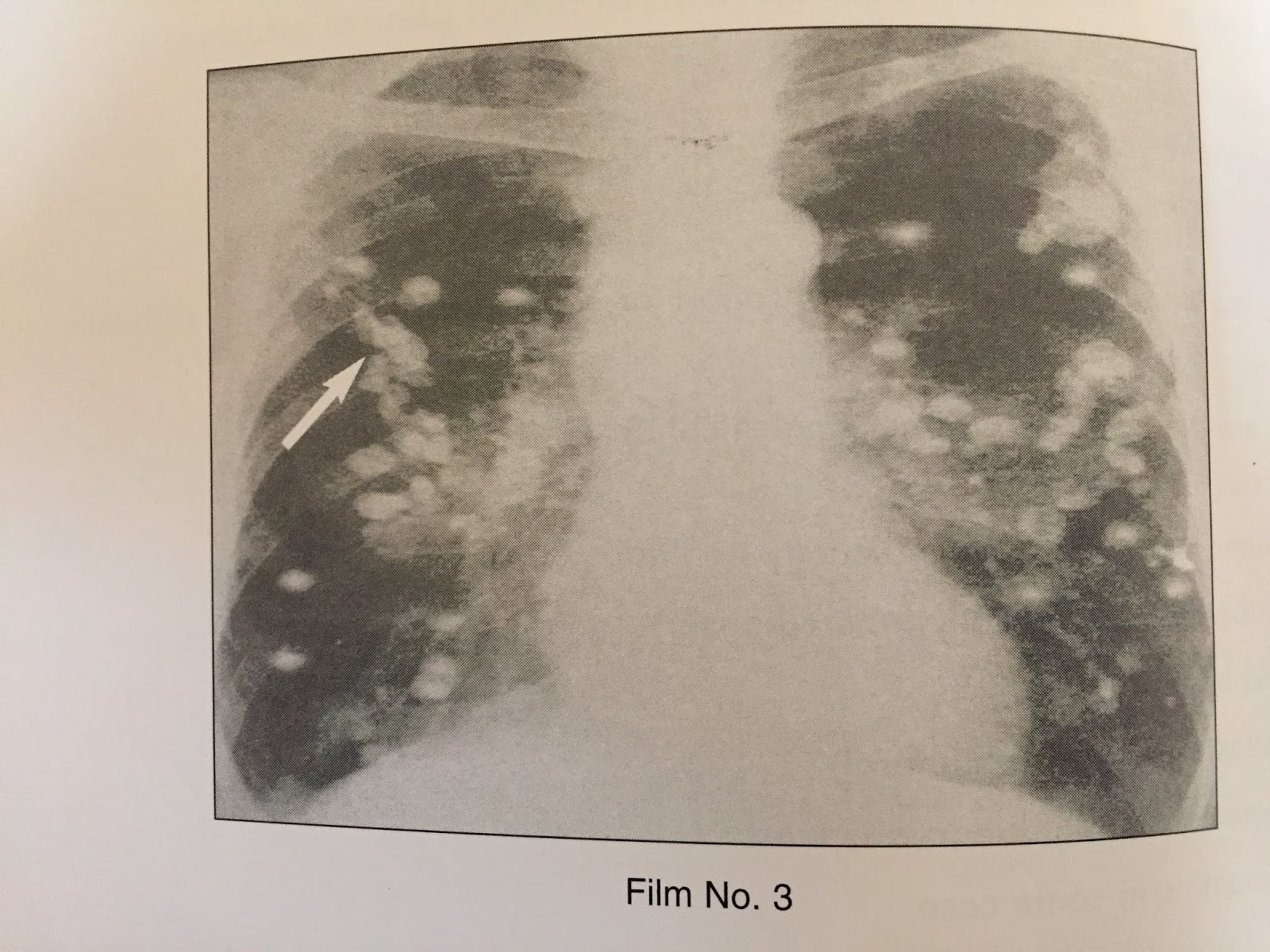XRAYS OF PULMONARY CALCIFICATION