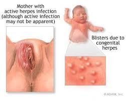 Obat Gatal-Gatal Pada Vagina Obat Gatal-Gatal Pada Vagina