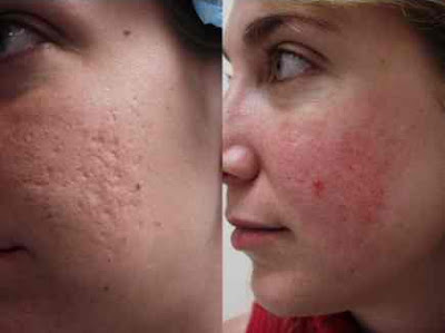 Acne - Causes, Types, Treatments, Overcome, Prevents, Foods - Ain Health