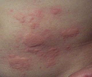 Stress-related rashes are itchy and swollen, which causes discomfort anxiety rash pictures.