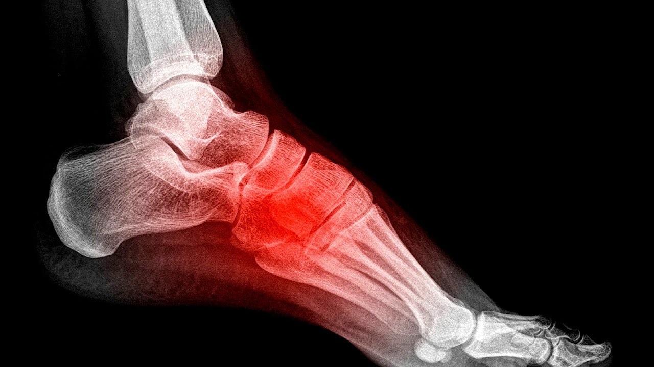 Foot Arch Injury Injury Choices