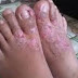 Bintik Merah Pada Kulit Telapak Kaki Dan Terasa Gatal