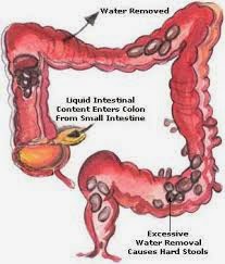 موقع افهم الربح علاج الامساك اسباب وطرق علاج الامساك الشديد والمزمن