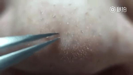 Day la cach giup ban gap mun dau den ra de ot - Anh 5