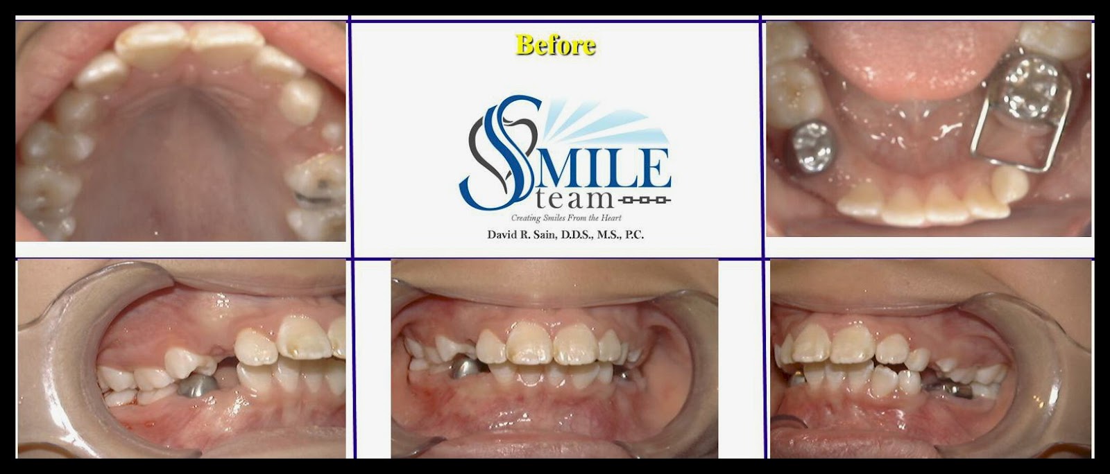 Smile Team Orthodontics What is a Jaw Corrector (Herbst Appliance) and
