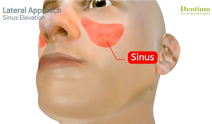 IMPLANTOLOGY: Sinus elevation - Lateral approach