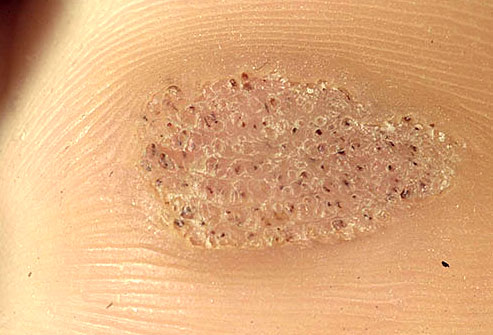 are flat warts contagious