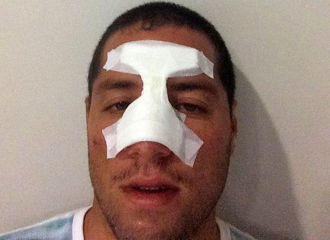 12+ Puñetazo Dado En La Nariz O Cara - AlcideJulia