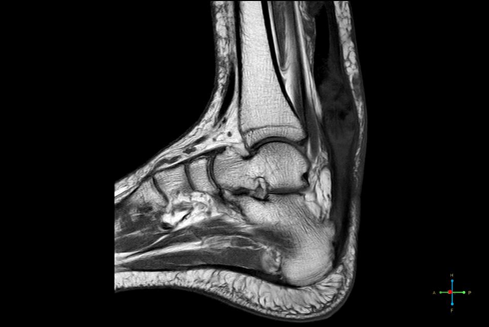 Achilles Tendon XanthomaMRI Sumer's Radiology Blog