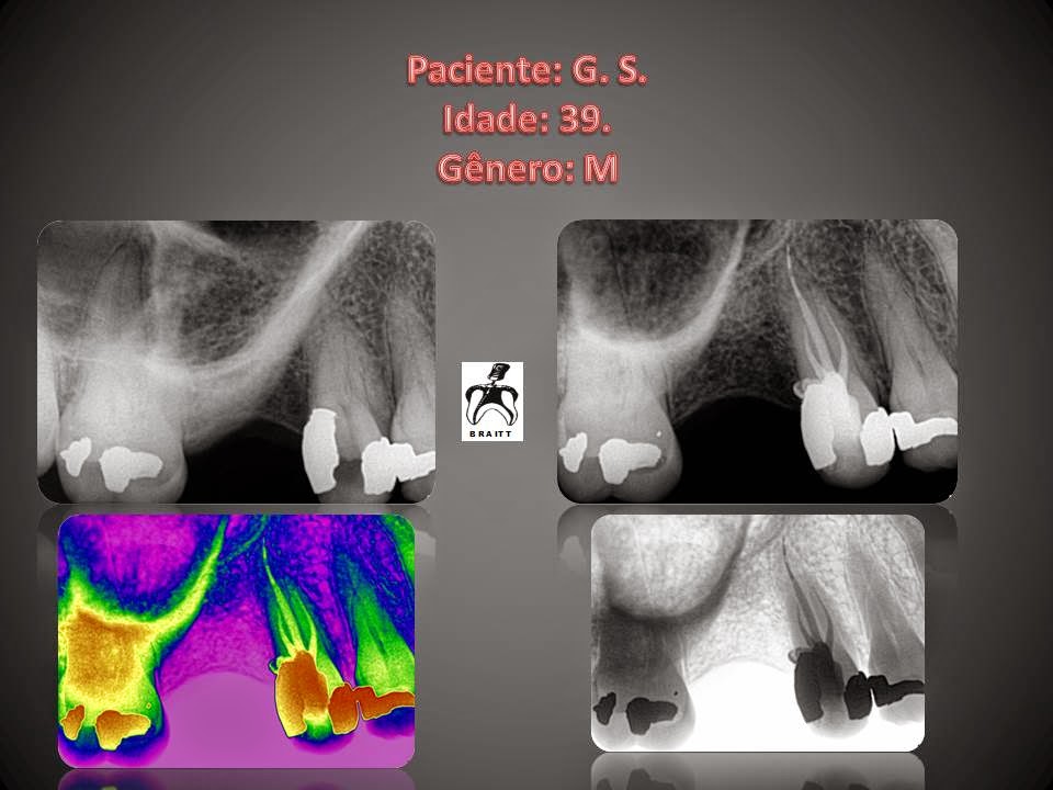Endodontia Dr Henrique Braitt Tratamento endodôntico em pré molar superior com canais A